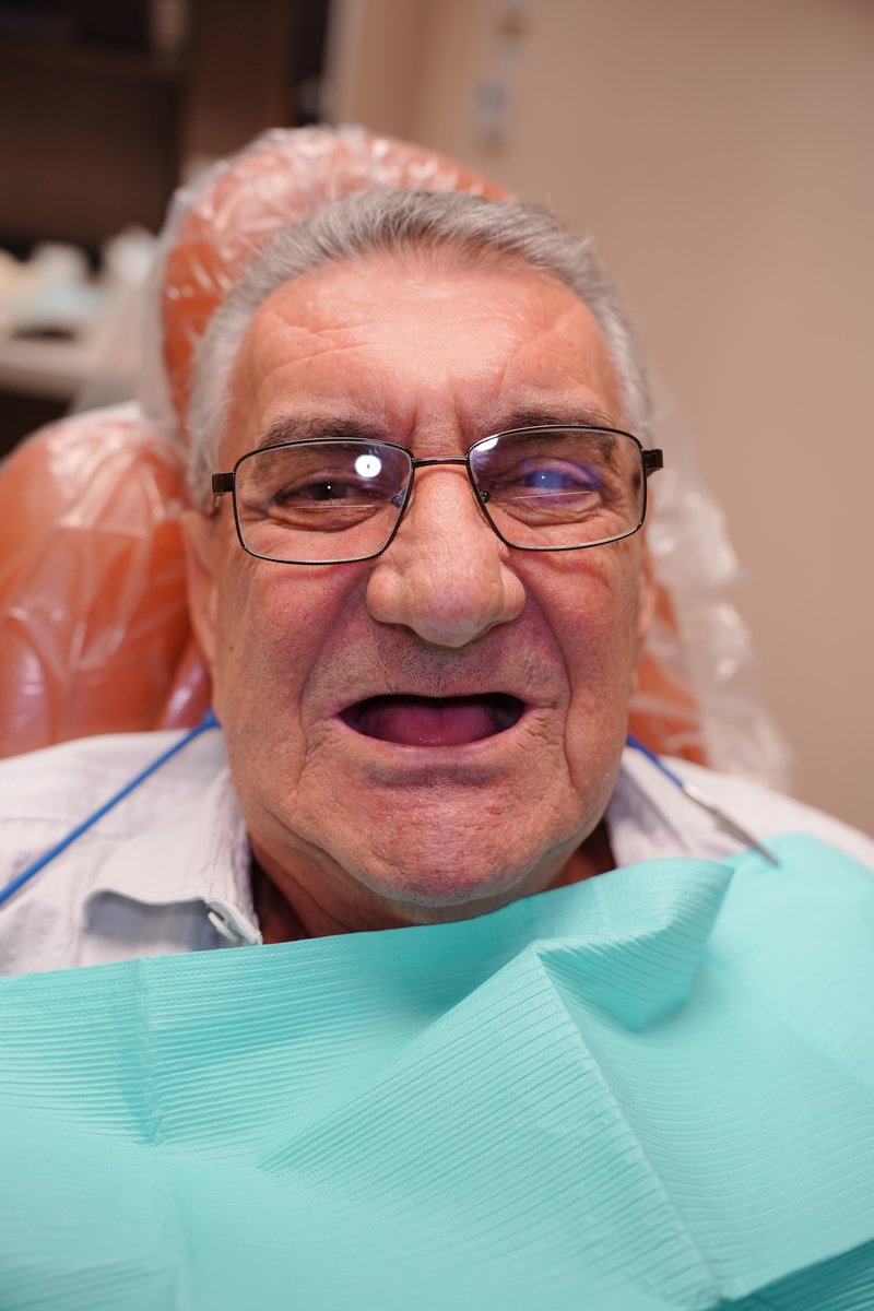 Patient before implant-supported dentures at Imaging Dentistry